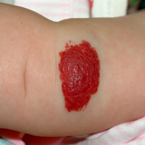 いちご状血管腫