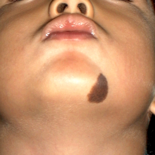 先天性色素性母斑