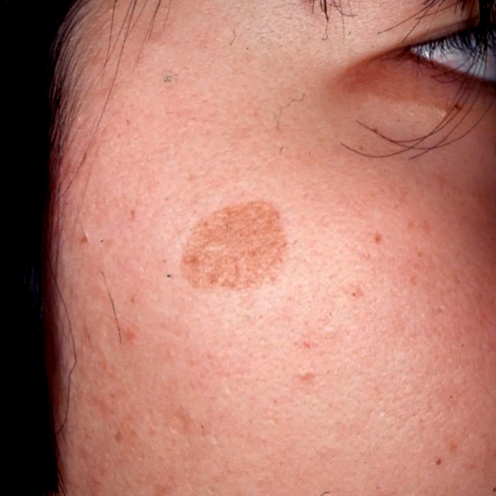 老人性色素斑（日光黒子）