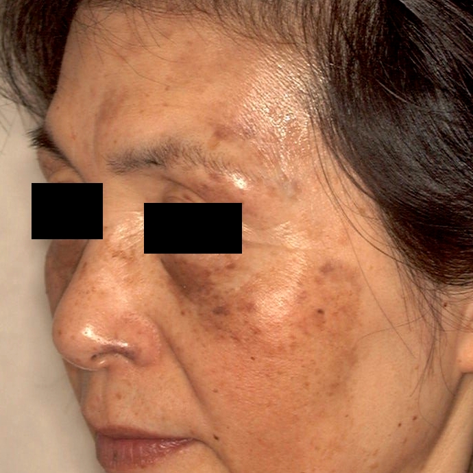 ADM（後天性真皮メラノサイトーシス）