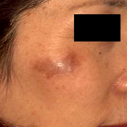 PIH（炎症後色素沈着）