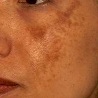 肝斑（くすみ）