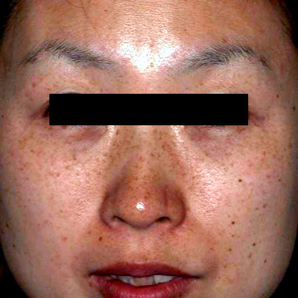 雀卵斑（ソバカス）